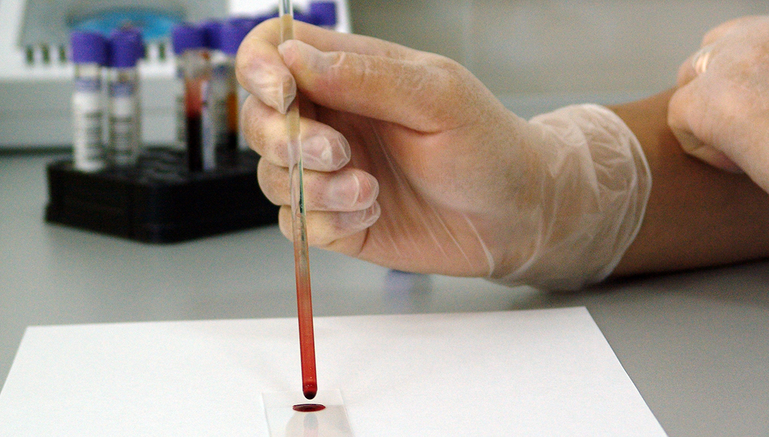 Blood test may help identify fetal alcohol disorders