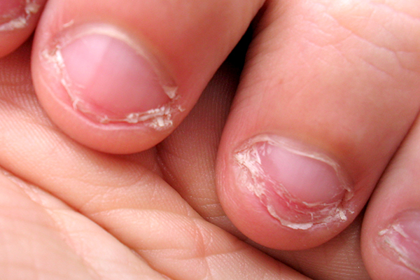 You can spread infection from nail to nail