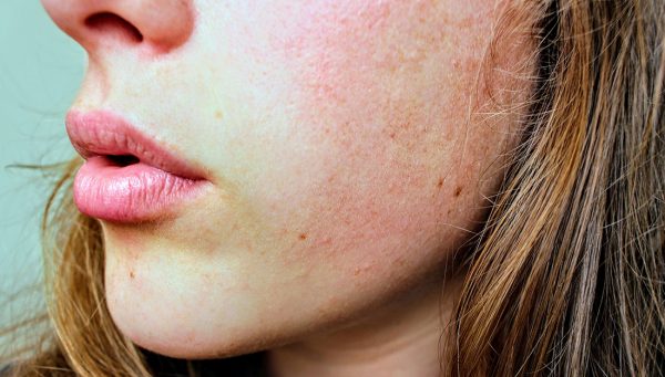 Close-up picture of a woman's jaw and cheek that shows dry skin